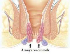 aranyercsomok